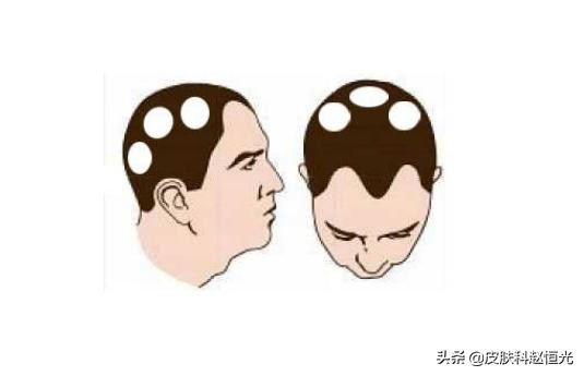 脱发不可挽救吗,脱发没有根治办法吗