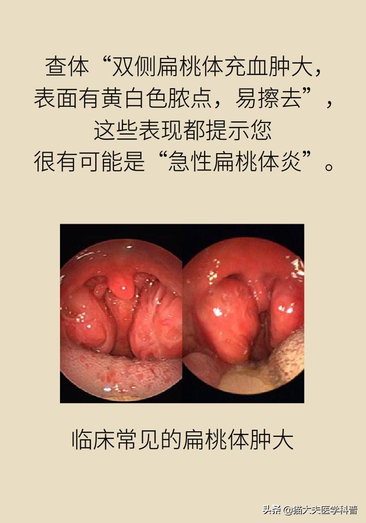 扁桃体肿大一侧和两侧区别,单侧扁桃体肿大患癌的几率是多少