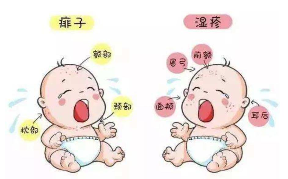 痱子和湿疹治疗偏方,夏季如何区分湿疹和痱子