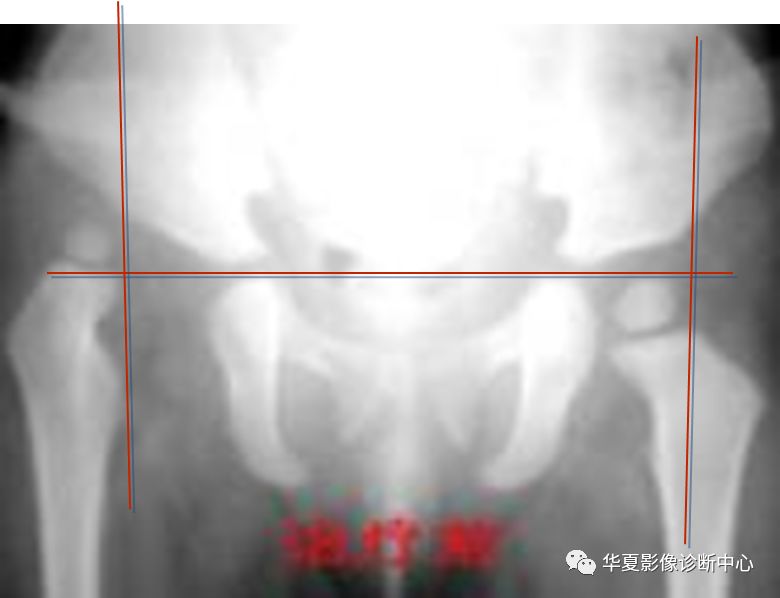 先天性髋关节脱位截骨术全过程,先天性髋关节脱位可以考驾驶证吗