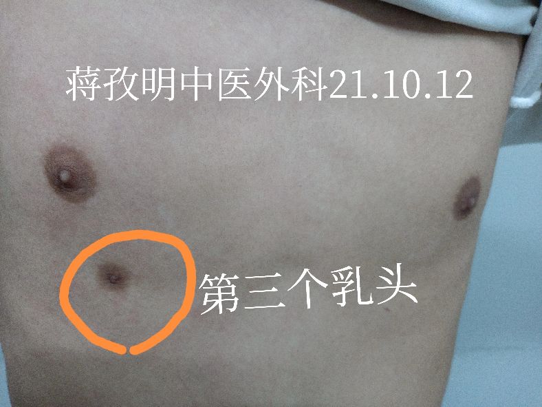 怪了,小伙子长了3个乳头