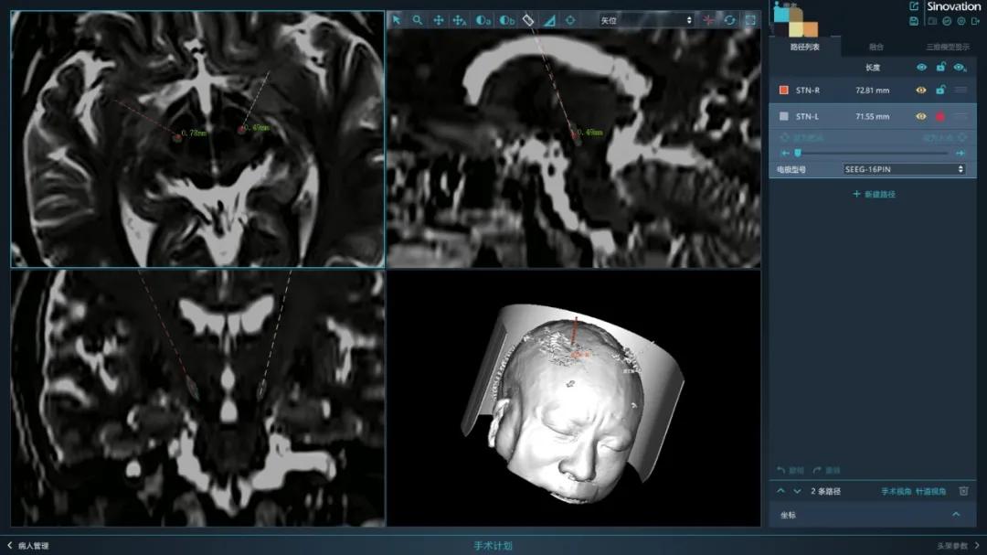 脑深部电刺激技术,中国首例脑深部电刺激手术