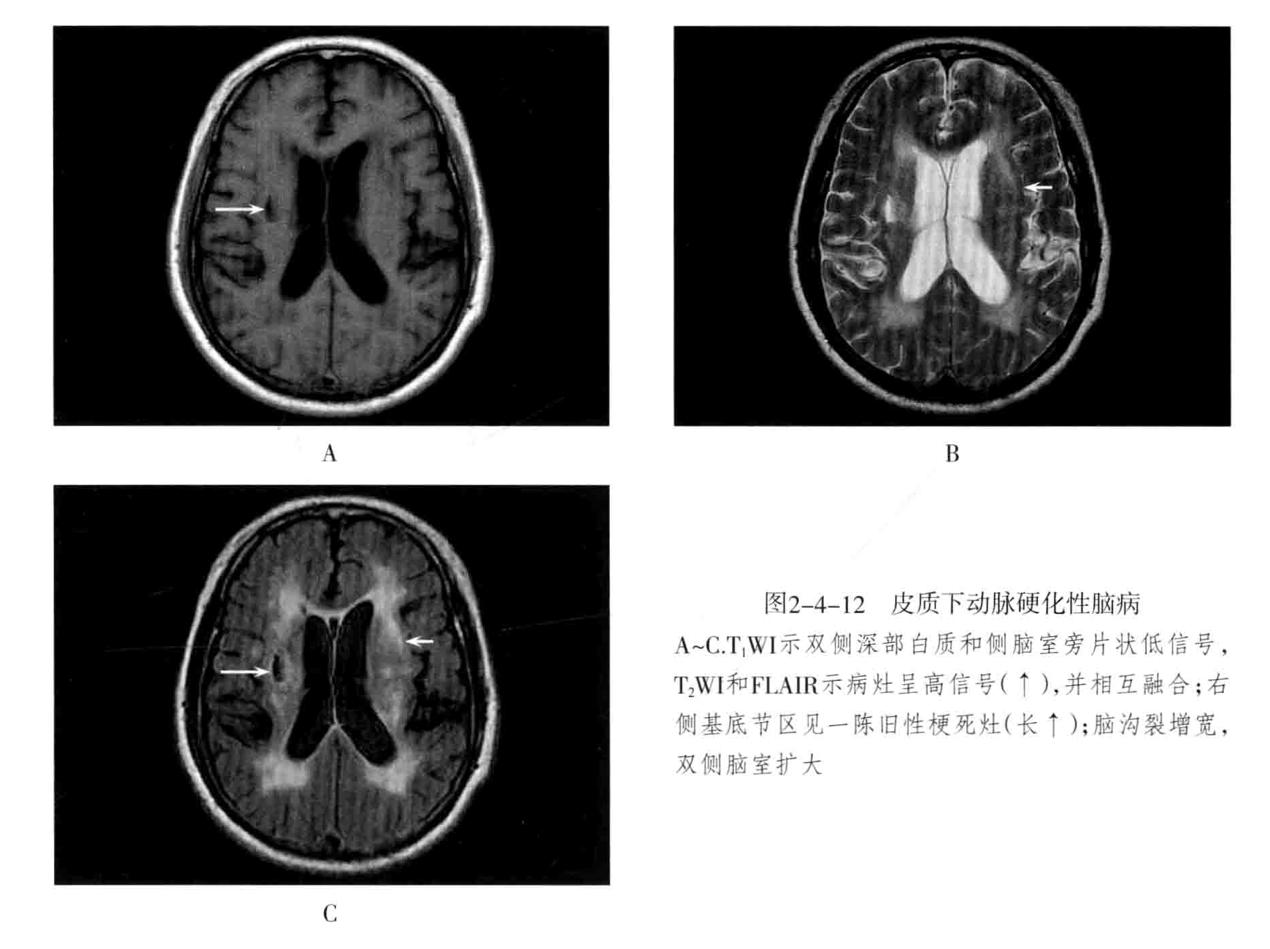 颅内血管轻度狭窄诊断标准,颅内血管先天变异影像