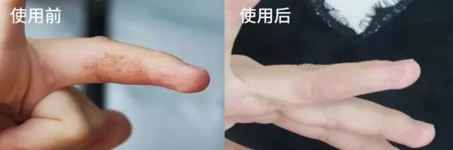 超临界蜂胶与普通蜂胶有几大优点,纯天然蜂胶的作用与功效