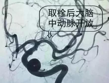 脚上暗藏化血栓开关,脚部静脉血栓的最快消除方法