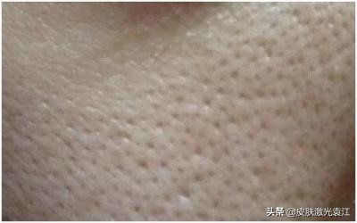 毛孔粗大5种类型改善方法,毛孔粗大程度分级