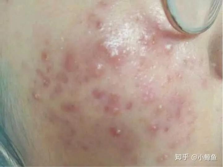 青春期没有长痘痘25岁了才长,为什么过了25岁感觉时间过得很快