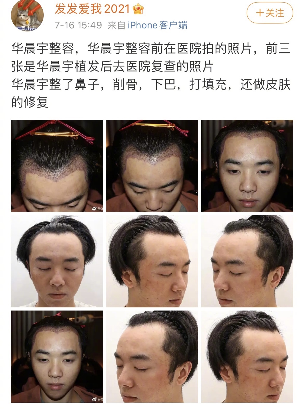 华晨宇是不是植发了,华晨宇是不是植发过