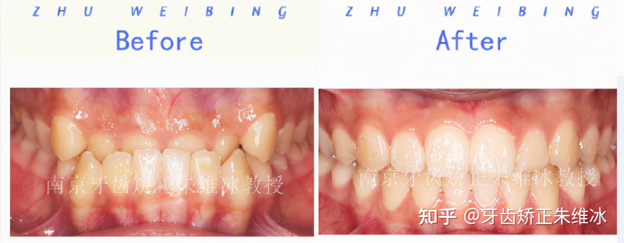 南京透明式牙齿矫正器地包天,18岁功能性地包天能改善面型吗
