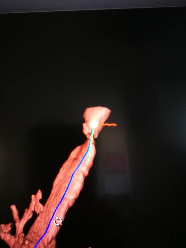 经支气管镜球囊扩张治疗气道狭窄,支气管镜球囊扩张操作视频