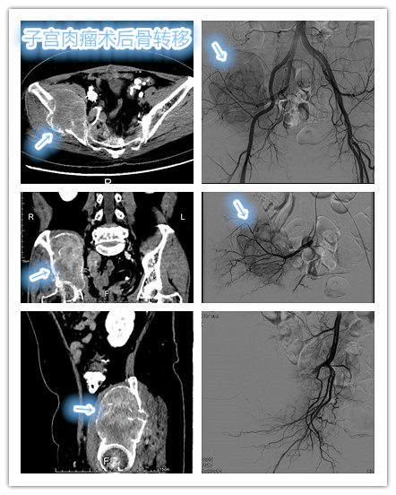 骨盆肿瘤手术做不了了怎么办,骨盆转移瘤