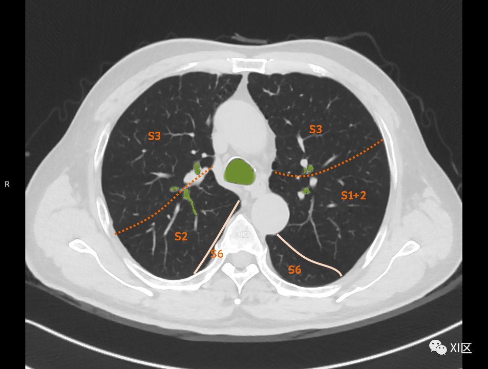 如此详细的肺部影像解剖，有点儿酷