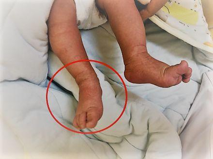 足内翻拇外翻是什么原因,足内翻足外翻的解决方法
