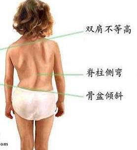 怎么知道脊柱侧弯的危害和症状,造成脊柱侧弯的原因主要是什么