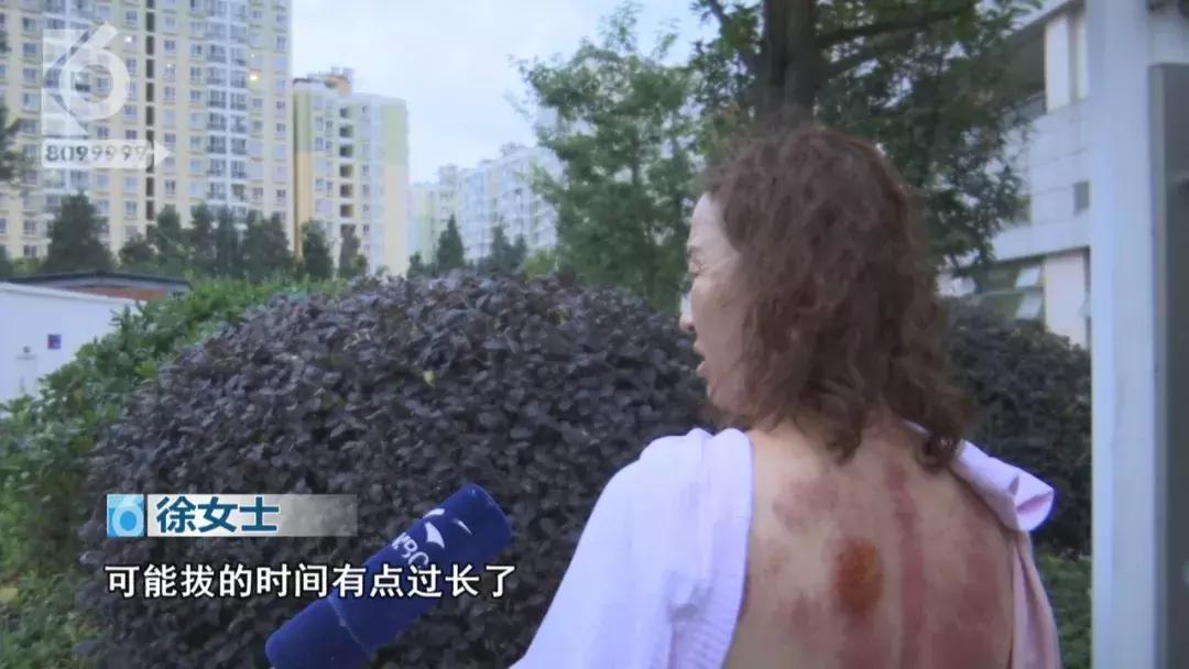 女性湿气太重拔火罐有用吗,拔火罐后有水泡是烫伤还是湿气