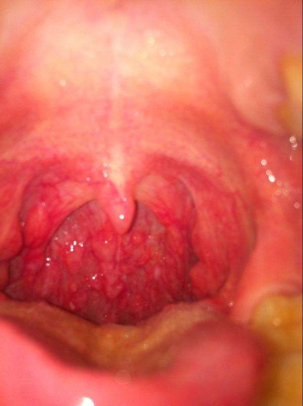 鱼刺卡住喉咙正确急救方法,一岁宝宝卡住喉咙急救视频