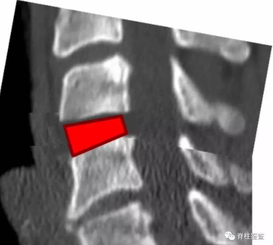 颈椎曲度变直诊断证明,3d演示颈椎生理曲度变直牵引过程