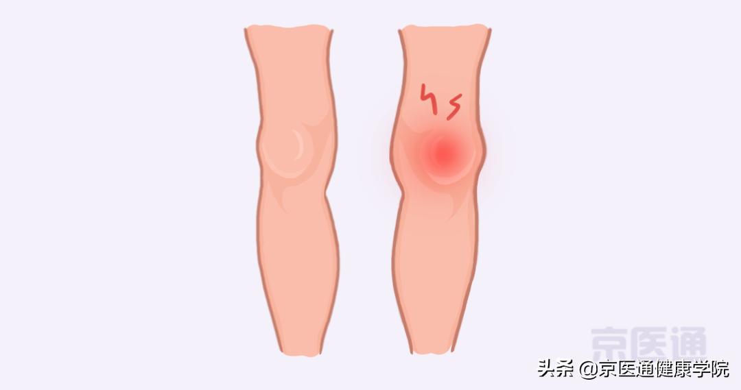 膝盖疼、腿疼、脚疼,5种跑步损伤,专家教你处理
