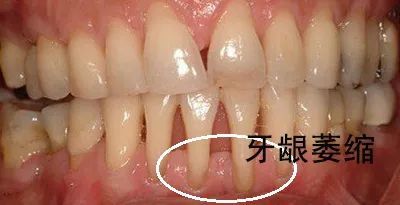 牙龈萎缩牙齿松动怎么挽救,牙龈萎缩牙齿松动严重怎么处理