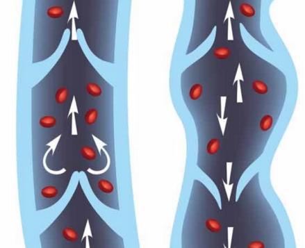 腿上静脉血管弯曲咋回事,腿血管变明显