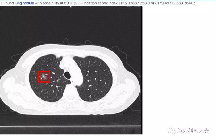 体检报告出是肺大泡就是肺结核吗,体检查出是肺大泡可信吗