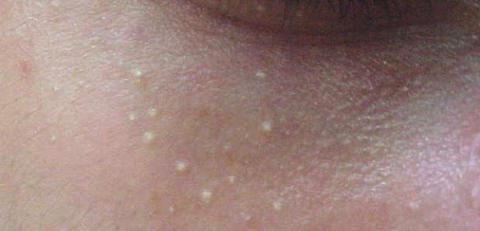 脂肪粒是什么样子的如何去除,顽固脂肪粒去除神器