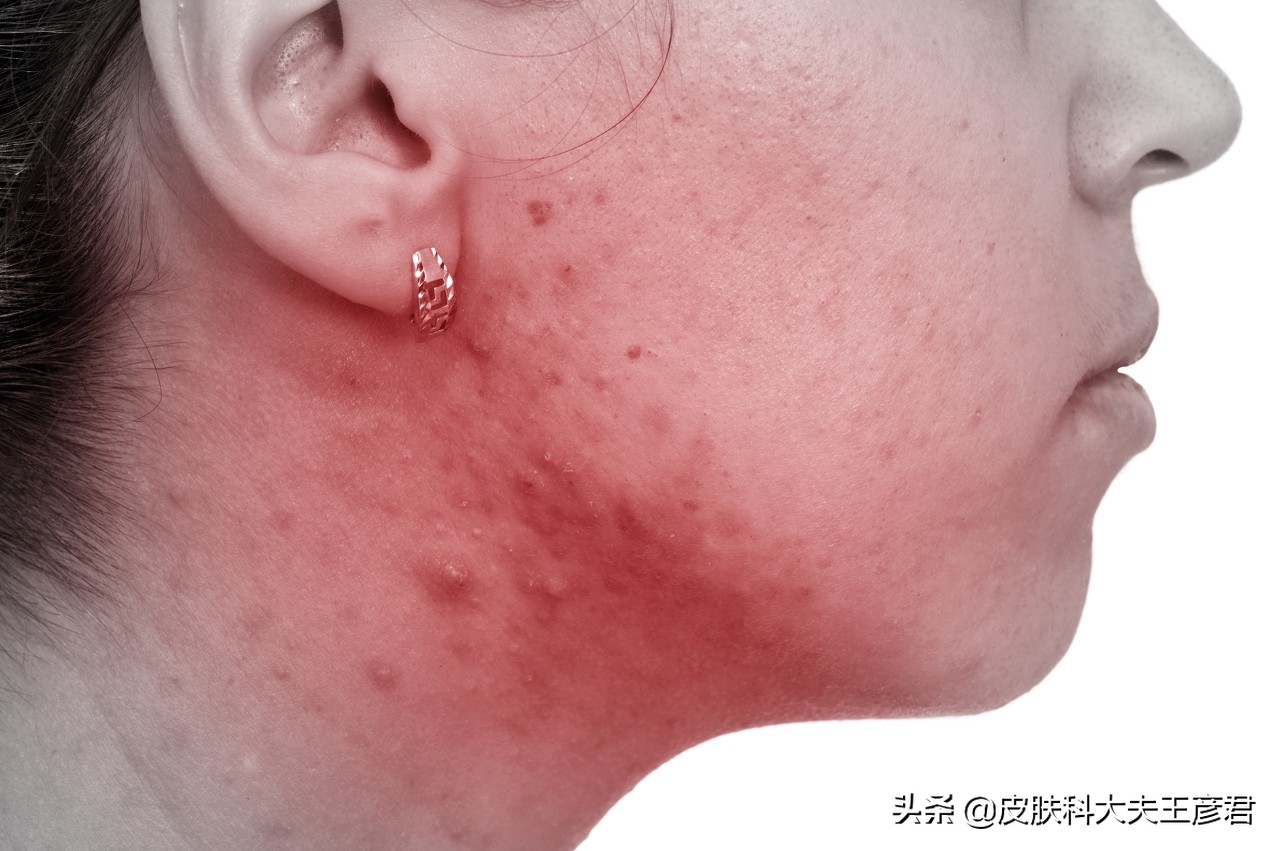 痘痘没冒出来变硬疙瘩用什么药膏,脸上痘痘变硬还凸出来挤不出东西