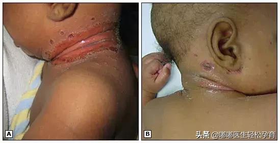 新生儿淹脖子破皮解决方案,婴幼儿脖子淹了破皮了怎么办