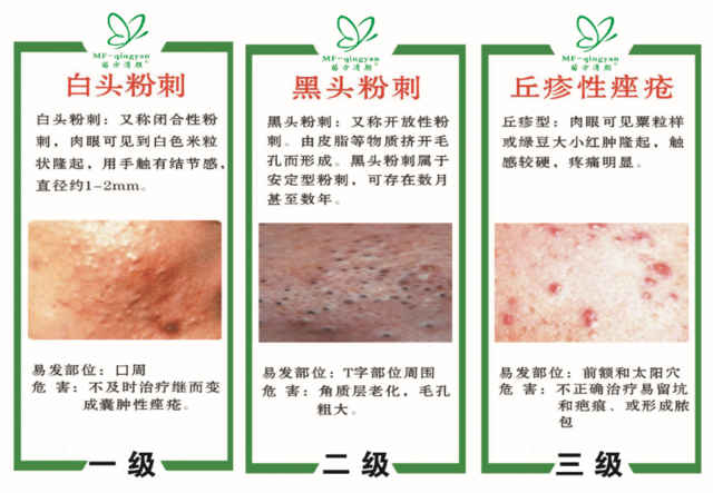 如何正确祛痘养好皮肤,战痘多年没有效如何正确祛痘