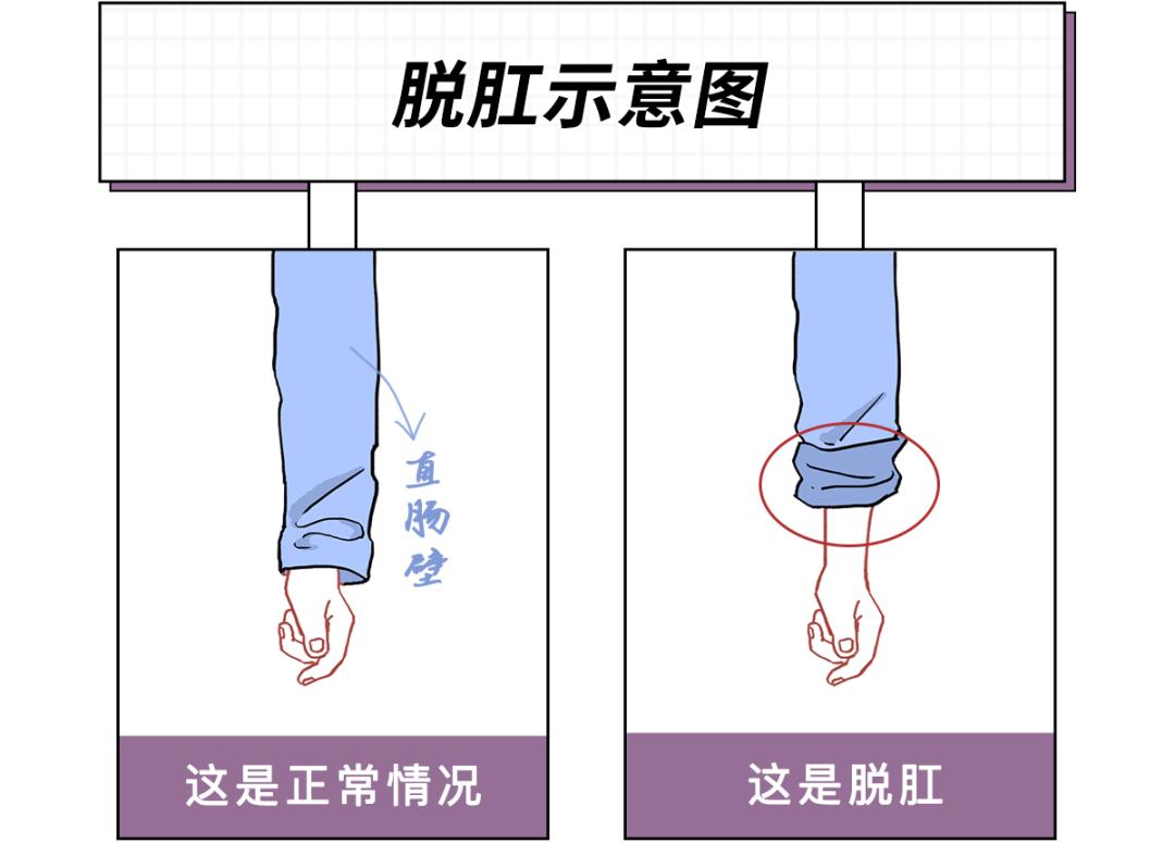 拉屎太用力脸上出红血丝了,用力拉屎会导致子宫脱垂吗
