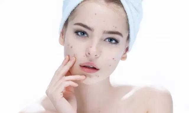 红色痘印和黑色痘印哪个严重,红色痘印和黑色痘印