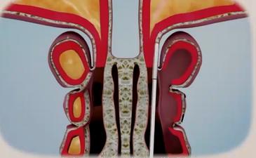 北京人民医院王旻做鼻炎手术,鼻窦炎怎么治疗协和