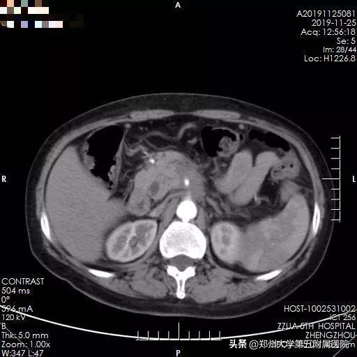河南省肿瘤医院射波刀治疗胰腺癌,郑大第一附属医院治疗胰腺癌