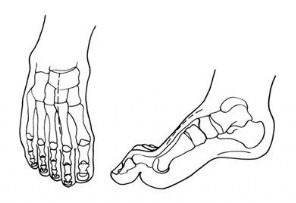 足内翻导致足弓疼,足内翻会导致什么腿型怎么改