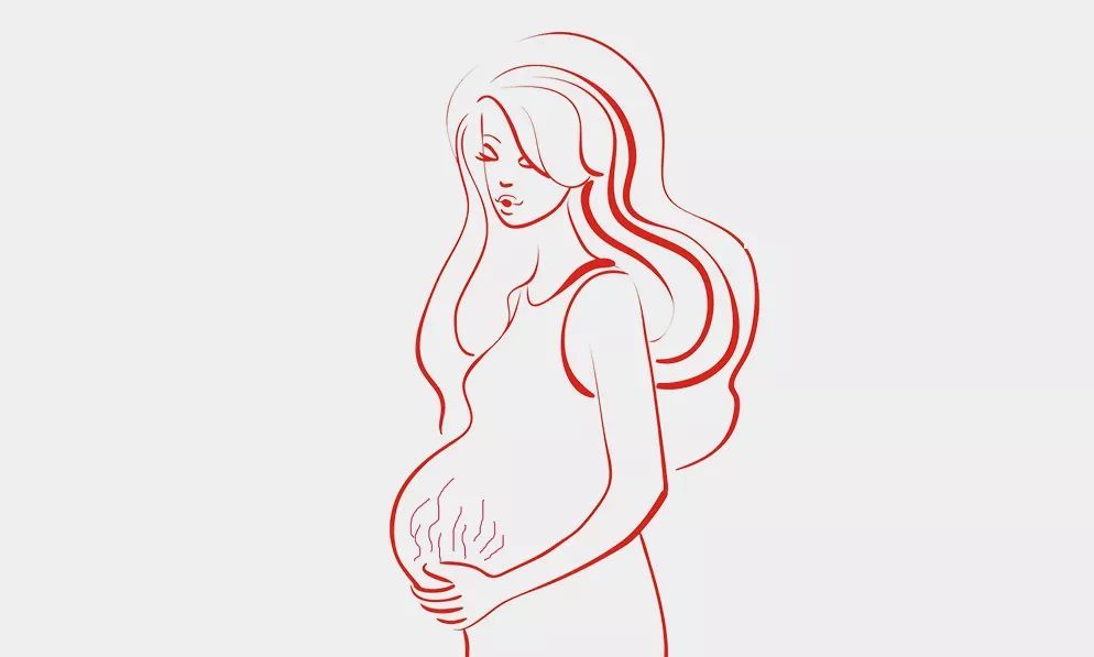 怀孕期间出现妊娠纹该怎么办,怀孕妊娠纹怎样消除