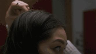 如何解决秃头和发际线高,脂溢性脱发头顶秃怎么办