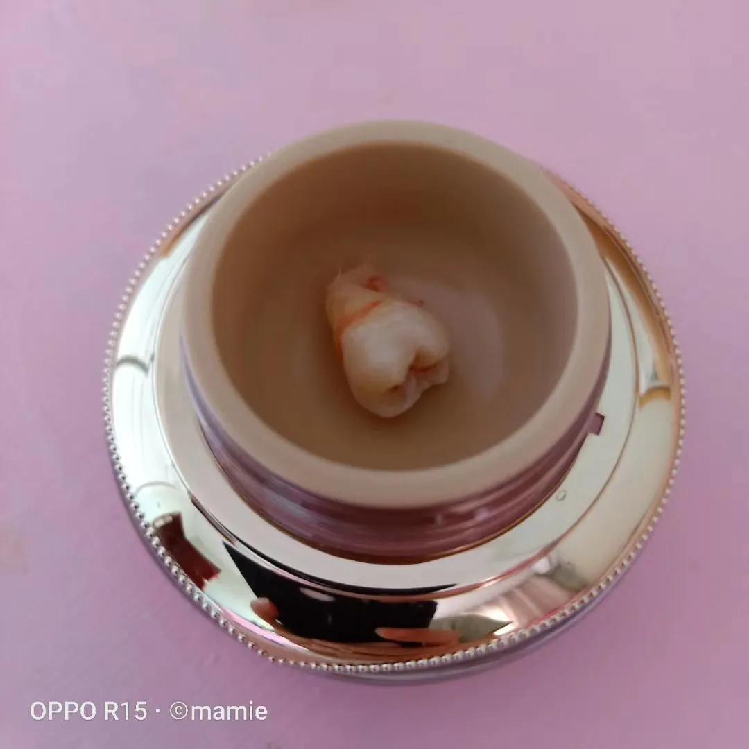 拔没长出来的智齿打麻药疼不疼,拔智齿是在牙根上打麻药