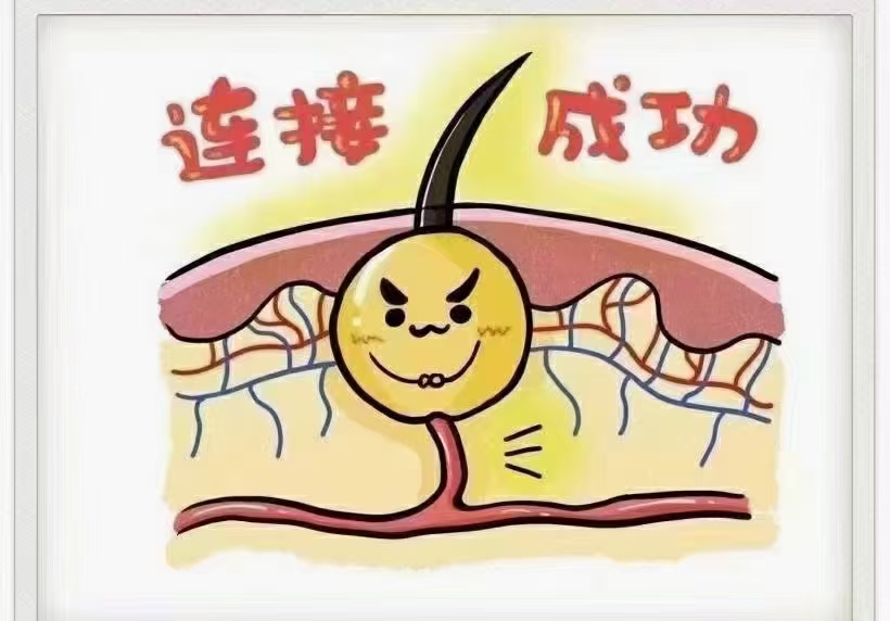 大家谈谈植发的经历,植发真的是一个漫长的过程