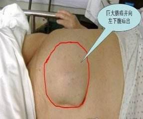 广州95岁老人疝气复发,广东省疝气最佳治疗年龄