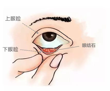眼睛里长结石是什么原因,宝宝眼睛里面长结石