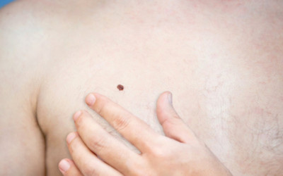 新生儿胎记色素痣怎么治疗,新生儿色素痣是怎么导致的