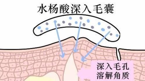 护理鸡皮肤的正确方法,身上的鸡皮肤怎样才能彻底消除