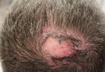 前胸后背长痘痘是毛囊炎吗,前胸后背很容易长痘痘中医治疗