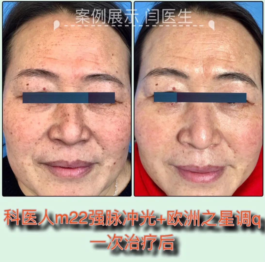 脸上有雀斑7秒钟搞定,雀斑一扫而光的原理