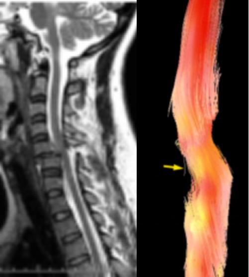 磁共振dti融合成像,磁共振dti成像作用