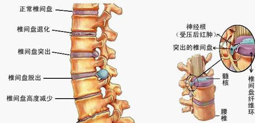 腿疼、腿麻、腰痛反复发作？那是因为没有找到治本的方法