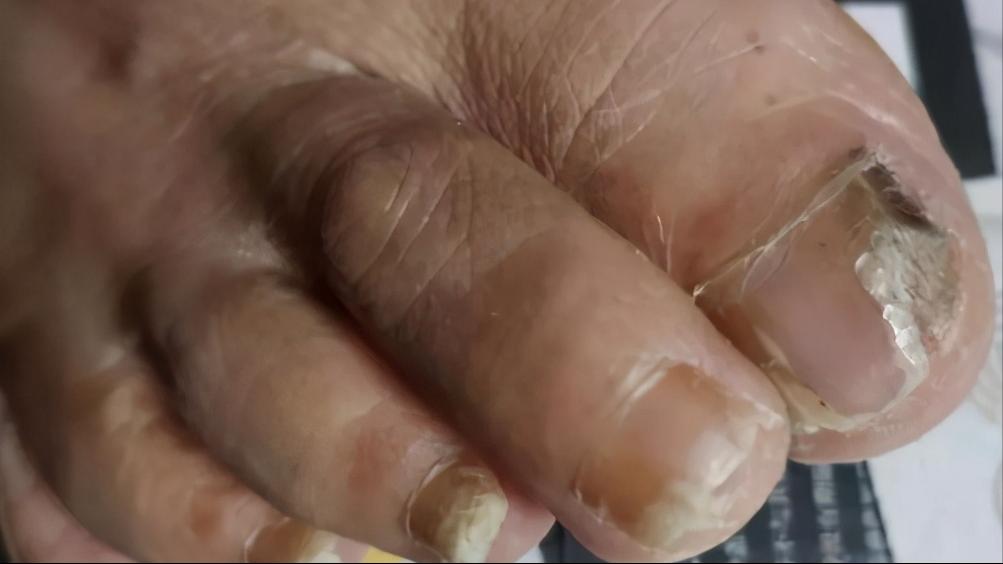 脚上干燥脱皮是真菌感染嘛,脚上因为真菌而开裂怎么办