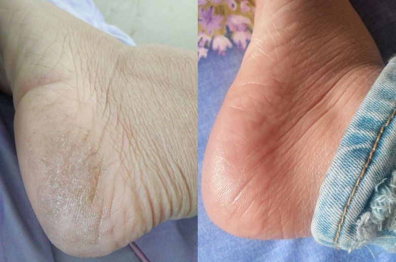 后脚跟干裂护足霜排行榜第一名,护脚霜脚后跟干裂修复霜国货