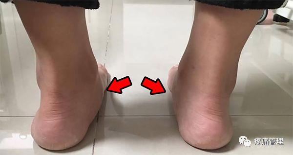 专门改善扁平足的运动,站着改善x型腿