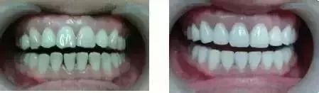 全瓷牙冠在保质期可以免费重做吗,全瓷牙冠价格表2021款报价